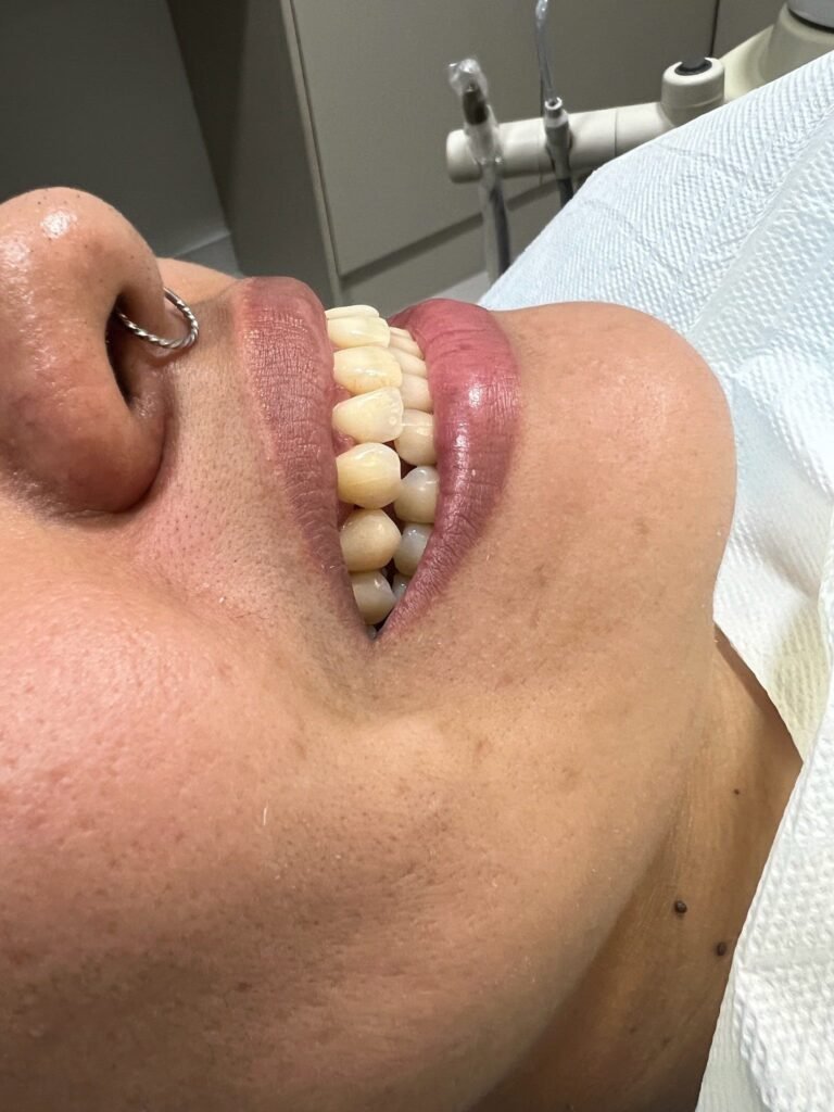 Quanto tempo dura um implante dentário?