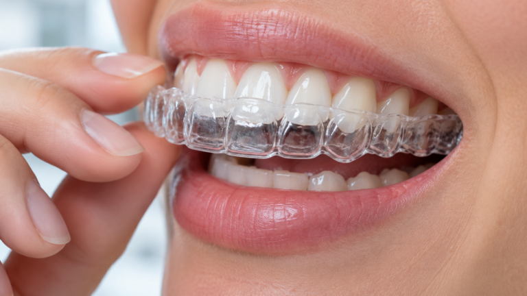 Alinhador invisível transparente sendo colocado sobre os dentes — Milano Odontologia, Americana-SP