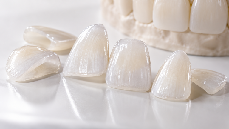 Lâminas de porcelana sendo posicionadas sobre modelo de dentes — Milano Odontologia, Americana-SP