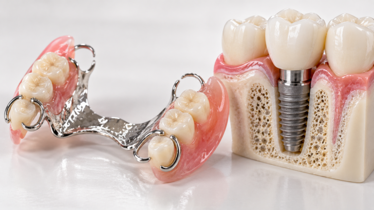 Prótese parcial removível ao lado de modelo de implante dentário — Milano Odontologia, Americana-SP